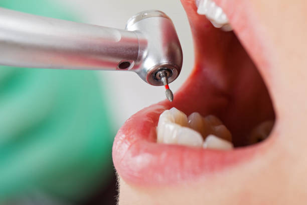 Best Emergency Wisdom Teeth Removal in Rossville, MD